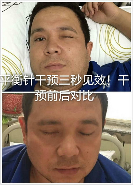 平衡针灸