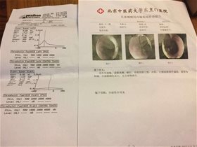 平衡针灸对儿童分泌性中耳炎一次见效