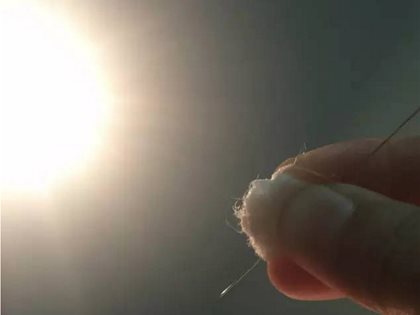 [平衡针论] 肾结石的疏解与平衡针原理