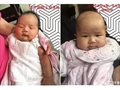 现代针灸学(平衡针灸)在儿科黄疸病中的应用与优势