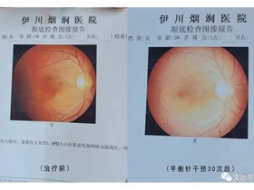 平衡针干预中心性浆液性视网膜病变并发视网膜脱离30次临床治愈