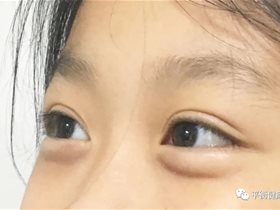 平衡针干预青少年近视跟踪报道
