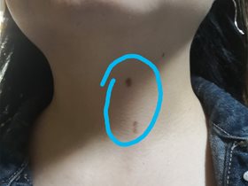 黑色素沉着平衡针三次症状消失