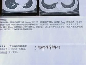 平衡针干预两例”肺磨玻璃样结节”效果显著