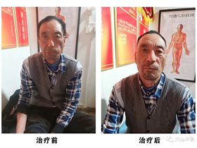 社区健康卫士：​王永杰运用平衡针脑技术干预面神经麻痹三例临床治愈