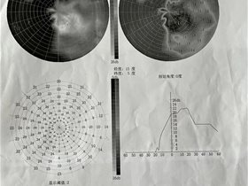 社区健康卫士:付燕医师运用平衡针20次干预一例视神经萎缩患者重见光明