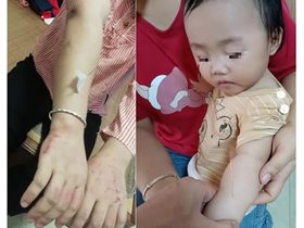 社区健康卫士：罗钟生医师运用平衡针脑技术调治产后抑郁症案例