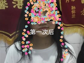 脑技术应用：平衡针干预一例初中生面瘫病例十次临床治愈